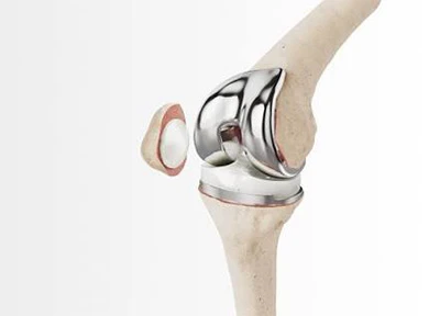 Load-Bearing Sites (E.G., Hip And Knee Joints) Load-Bearing Sites (E.G., Hip And Knee Joints)