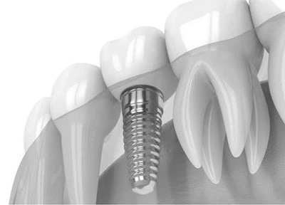 Soft-Tissue Interfaces (E.G., Dental Implant Abutments And Cranial Repair Plates) Soft-Tissue Interfaces (E.G., Dental Implant Abutments And Cranial Repair Plates)