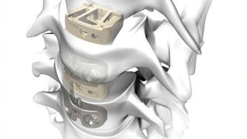 Spinal fusion cage Spinal fusion cage